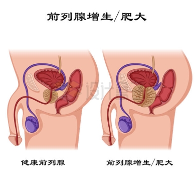 前列腺增生/肥大男性生殖系统疾病解剖图9512296矢量图片免抠素材
