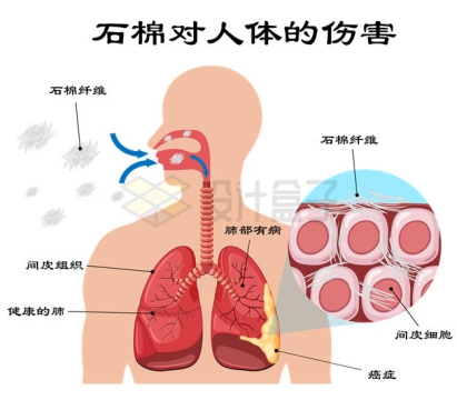 肺部吸入石棉纤维对人体的伤害示意图6655999矢量图片免抠素材