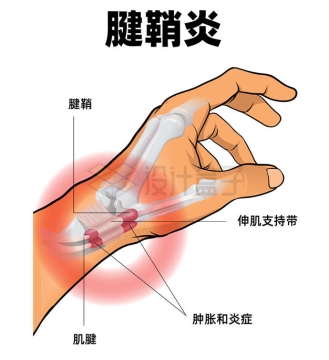 手指腱鞘炎结构示意图8210893矢量图片免抠素材